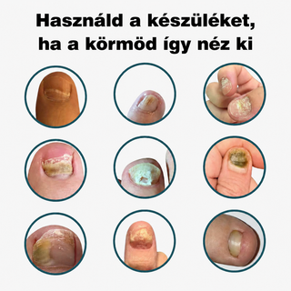 NuvoCare – Kékfényes kezelés körömgomba ellen otthon
